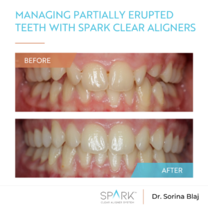 Managing partially erupted teeth with Spark Clear Aligners
